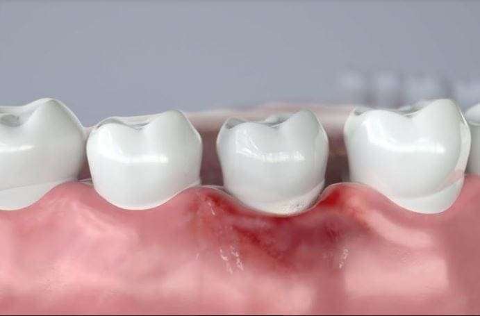 Μάτωμα των ούλων: Πέντε λόγοι που ματώνουν τα ούλα στο βούρτσισμα